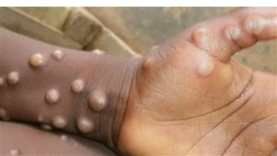 الفئات العمرية الأكثر عرضه للإصابة بمرض جدري القرود