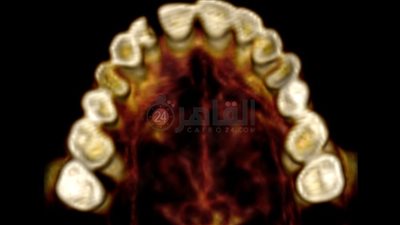 جراح أسنان: علامات بالفم قد تكشف عن مخاطر أمراض القلب