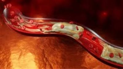 تقليل تدفق الدم.. ما هي عوامل الخطر الرئيسية للإصابة بمرض الشريان المحيطي؟