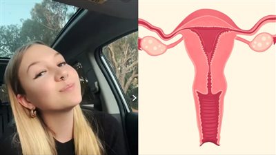 بعد ولادتها دون جهاز تناسلي.. صدمة الأطباء بسبب نمو عنق رحم لفتاة أسترالية