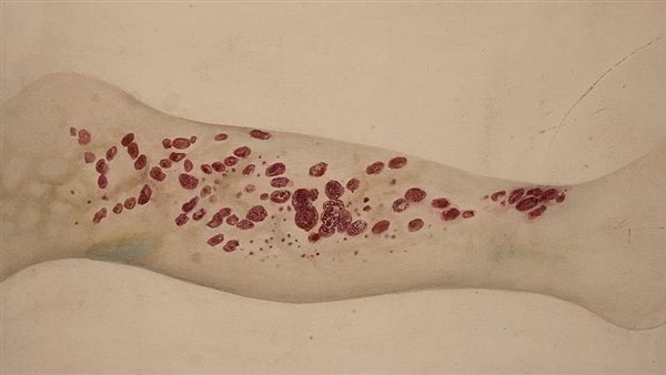 مرض الإسقربوط