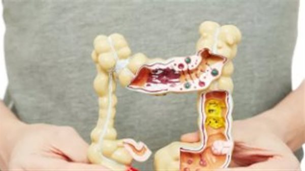 وصفة للإمساك