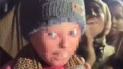 صغيرة فلسطينية تفقد القدرة على غلق عينيها بعد إصابتها جراء قصف إسرائيلي