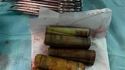 طبيب بقصر العيني يستخرج 6500 جنيه من بطن مريض (صور)