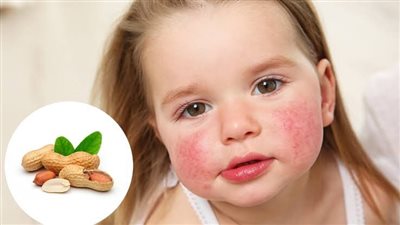 تناول الأطفال لمنتجات الفول السوداني في سن مبكرة يمكن أن يعالج حساسية الطعام| دراسة