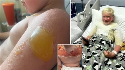 صغير بريطاني يعاني من حروق بالغة بسبب صن بلوك منتهية الصلاحية