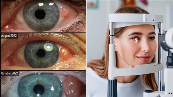 سرطان العين