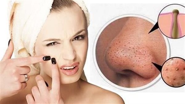 وصفة لإزالة الحبوب