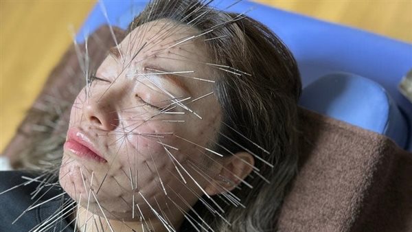 علاج الوخز بالإبر