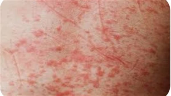 حمى الوادي- تعبيرية