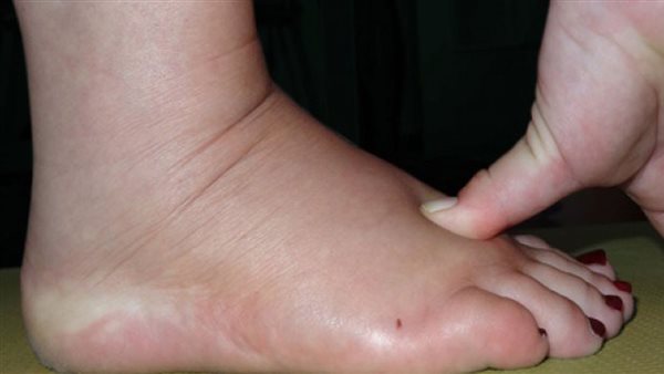 أسباب تورم القدمين