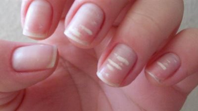 علامات تظهر على الأظافر تشير لبعض الأمراض 