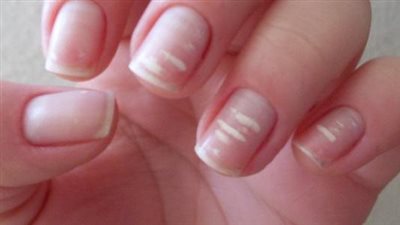 أطباء يحذرون: علامة في الأظافر قد تسبب الموت المفاجئ