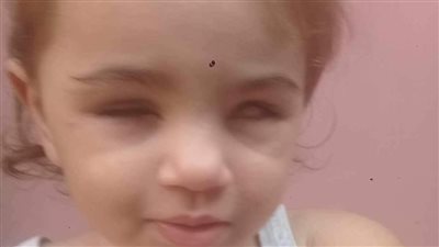 فلسطيني يستغيث لعلاج ابنة أخيه: فقدت عينها في الحرب وتحتاج لزراعة عين صناعية