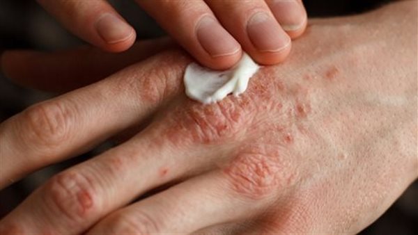 الصدفية - أرشيفية