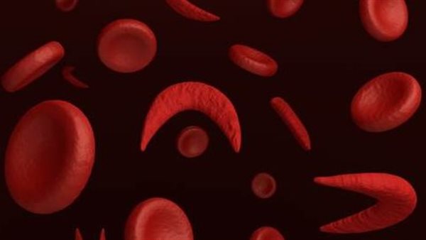  مرضى فقر الدم المنجلي