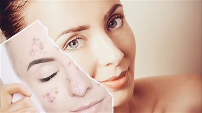 كيفية استخدام ماء الورد للبشرة الدهنية.. أضرار قد تجلبيها لبشرتكِ