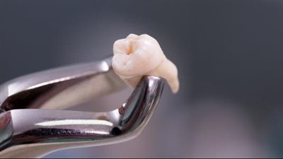 تفسير خلع الضرس في المنام وعلاقته بقطع الأرحام.. 7 دلالات لهذا الحلم