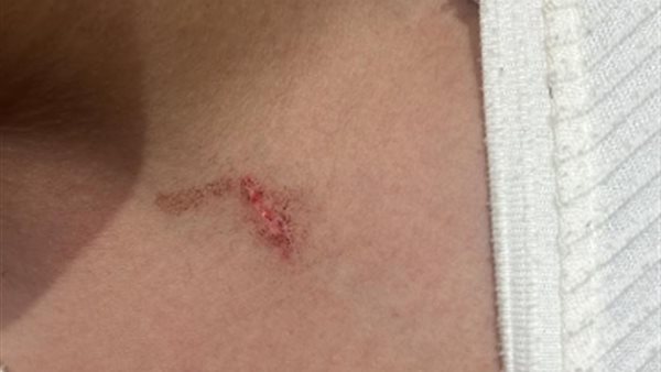 إصابة التلميذ