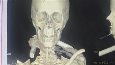 سيخ حديد دخل في رقبته.. فريق طبي بأسيوط ينجح في إجراء عملية جراحية دقيقة لمصاب بجرح غائر