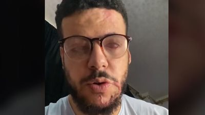 شاب يتعرض لحادث مأساوي خلال عمله بمصنع كيماويات زراعية في الشرقية: الحروق شوهت جسمي وعنيا راحت