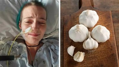 إصابة سيدة أمريكية بمرض خطير نتيجة تناول الثوم