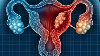 يسبب نزيفًا شديدًا.. طبيب يحذر من انتشار مرض بين الفتيات المراهقات 