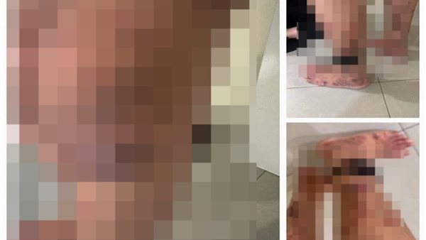 آثار مرض الجرب على