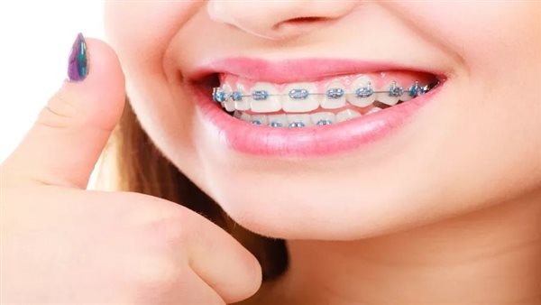 تقويم الأسنان 