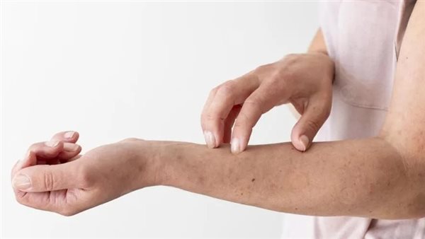 حساسية الطعام 