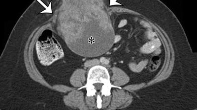 أسرة مسنة مصابة بالسرطان تستغيث لمساعدتها في تكاليف العلاج: الدواء غالي ومش لاقيينه