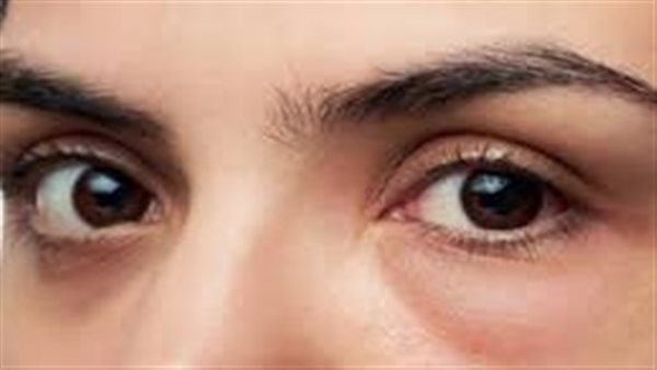 انتفاخ العين 