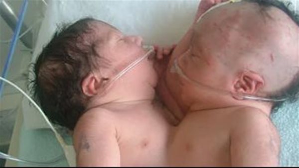 التوائم الملتصقة