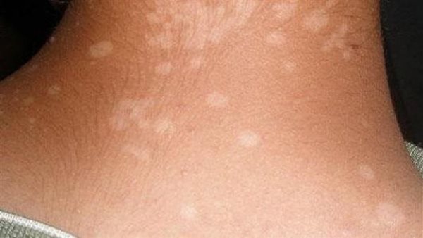 البقع الجلدية البيضاء