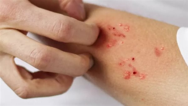 الجرب الجلدي