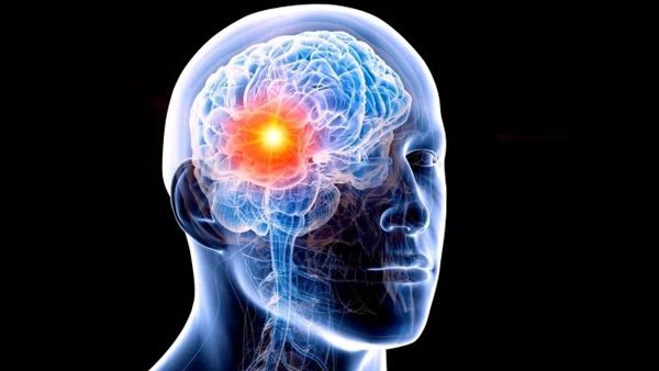 سرطان الدماغ 