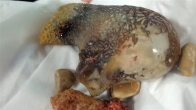 وزنها كيلو جرام.. نجاح جراحة فريدة لإزالة حصوة كبيرة من بطن مريض بالأقصر| صور