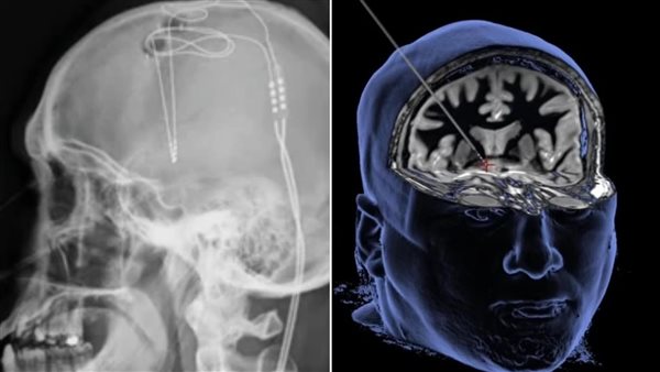 علاج الدماغ من الادمان