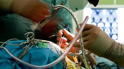 جهاز ثوري بعالم الجراحة.. باحثون يطورون شريحة جرافين لتحديد موقع أورام المخ