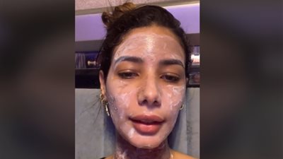 نفسيتي اتدمرت.. فتاة تستغيث من مركز جلدية في الإسكندرية: الدكتورة حرقت لي وشي ورقبتي