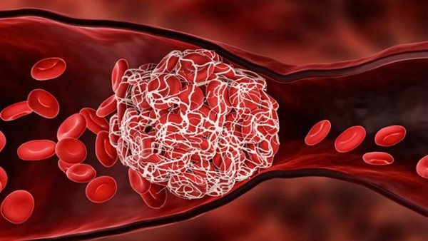 جلطات الأوعية الدموية