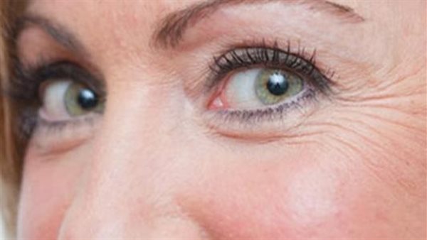 تجاعيد حول العين