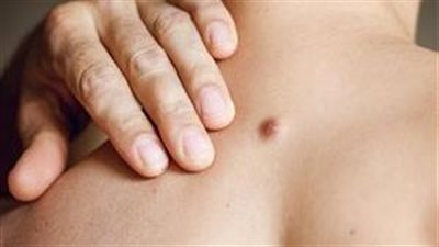 تظهر في شكل نتوءات جلدية.. ما هي متلازمة كاودن الوراثية؟