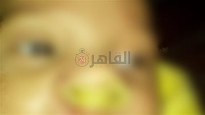 صحة دمياط: تعاون طبي ناجح لعلاج طفل مصاب بشفة أرنبية وأسنان إضافية