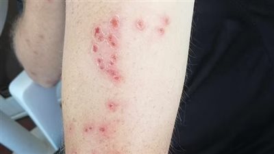 وسط غضب النزلاء.. انتشار وباء بق الفراش في منتجع سياحي شهير ببريطانيا