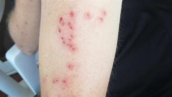 بق الفراش في بريطانيا