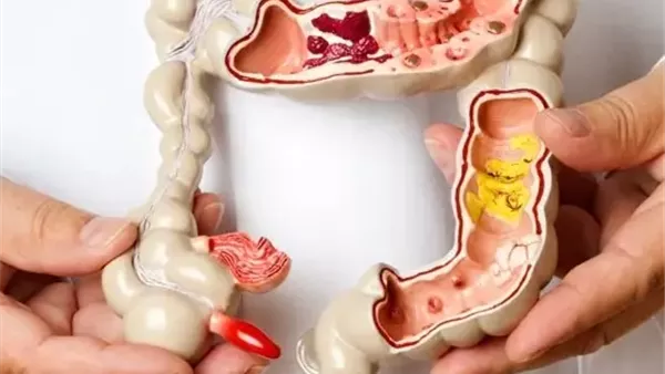 سرطان القولون