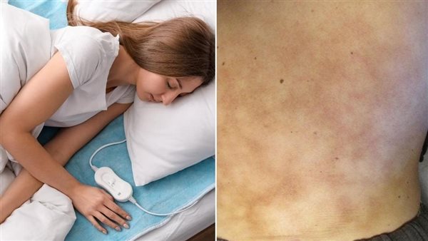 مرض جلدي - صورة تعبيرية