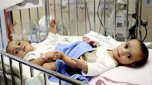 توأم ملتصق - أرشيفية