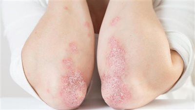 دراسة: الأطعمة شديدة المعالجة تتسبب في الإصابة بمرض الصدفية